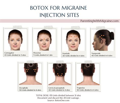 Botox For Migraine Everything You Need To Know — Parenting With Migraine