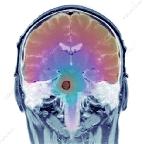 Brain Tumour Mri Scan Stock Image M1340802 Science Photo Library
