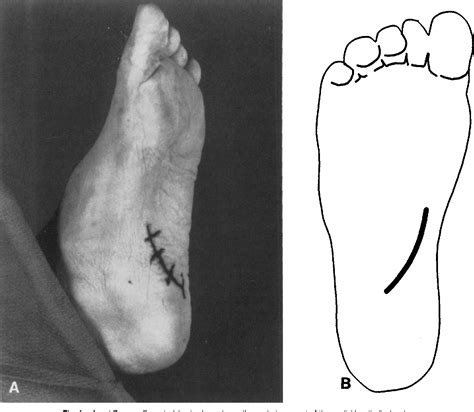 Figure 1 From Proximal Medial Longitudinal Arch Incision For Plantar