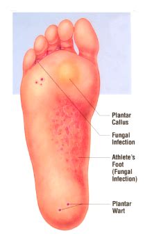 Immunotherapy for recalcitrant, recurrent or extensive warts, e.g. Planters Wart PNG Transparent Planters Wart.PNG Images ...