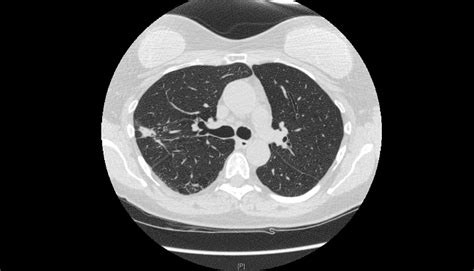 Cureus A Case Of An Enigmatic Pulmonary Infiltrate