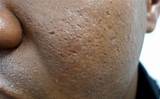 Pictures of Ice Pick Acne Scars