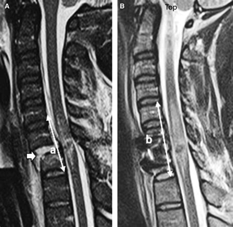 Extent Of Spinal Cord Decompression In Motor Complete American Spinal