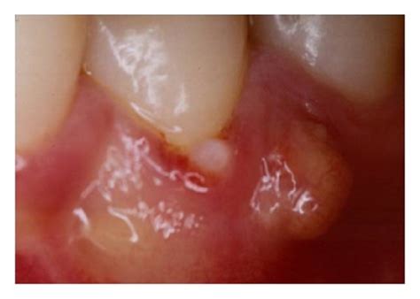 Gingival Abscess And Suppuration In The Premolar Area Download