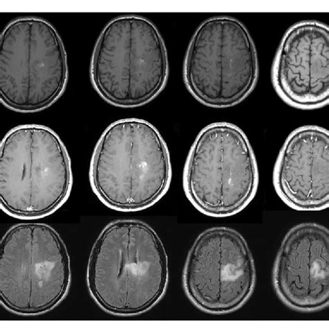Brain Magnetic Resonance Imaging Mri Findings A Axial T1 Weighted Download Scientific