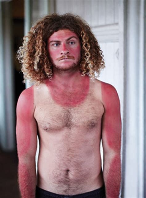 50 People Having Their Worst Day Ever Very Bad Day Funny Sunburn Sunburn Pictures Funny