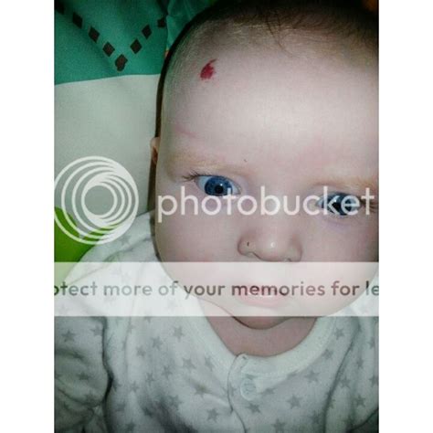 Beautiful Birthmarks Pic Babycentre