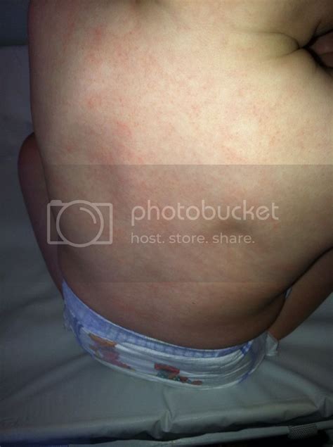 Wheezing or shortness of breath food allergies can also result in nausea, vomiting, or abdominal pain. Bumps on LO's back..pics | BabyCenter