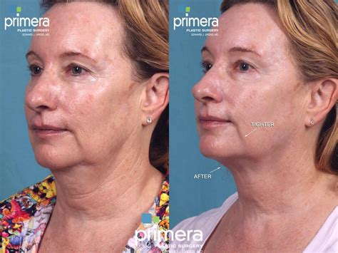 Ultherapy Before And After Pictures Case Orlando Florida Primera Plastic Surgery