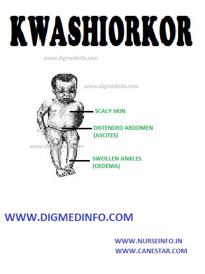 Kwashiorkor General Features Pathology And Clinical Features Nurse