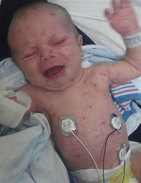 A Neonate With A Widespread And Worsening Vesicular Rash Consultant360