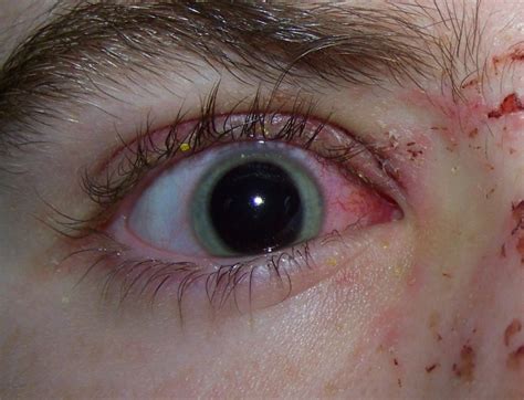 Eye Injury Eye Injury That Can Leads To Compensation Claim