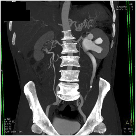 Obstructed Left Ureter With A Ureteral Calculi Genitourinary Case