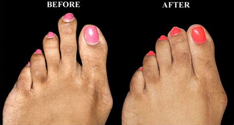 Toe Shortening Surgery In Chicago Il Keyes For Toes