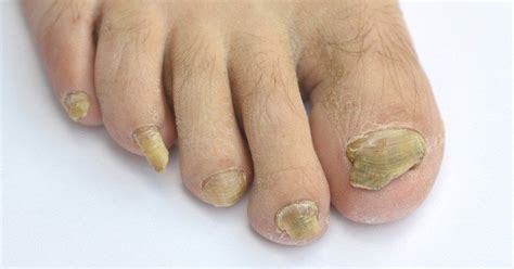 Home Remedies To Get Rid Of Yellow Nails And Nails Fungus Toenail
