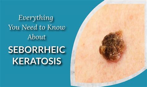 Seborrheic Keratosis What It Is What To Do About It