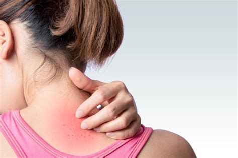 How To Tell Whether That Itchy Rash Is Eczema Or Psoriasis