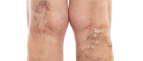 Varicose Veins More Than Skin Deep Understanding The Health Risks