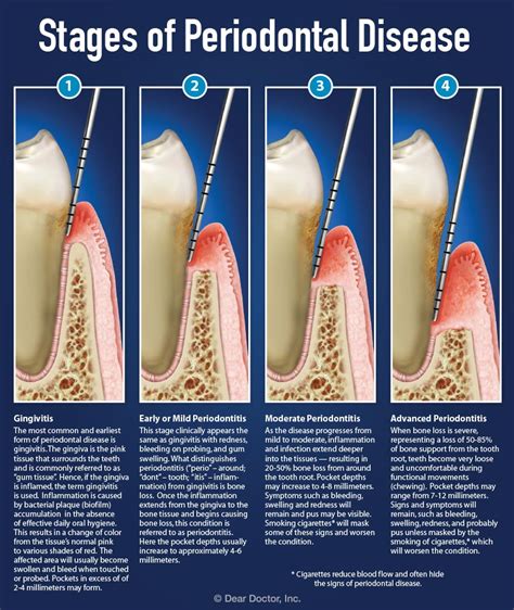 What Are The Stages Of Gum Disease Britten Perio
