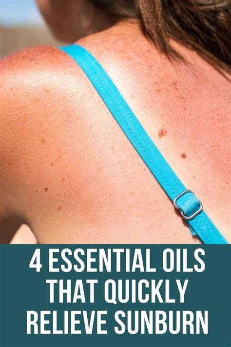 4 Essential Oils That Quickly Relieve Sunburn Essential Oil For