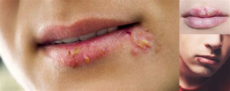 Herpes Labial ¿porqué Sale Contagio Síntomas Y Tratamiento Efectivo