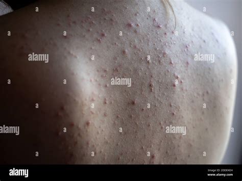 Woman Back With Acne Red Spots Skin Disease Stock Photo Alamy