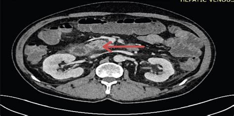 Case Report Groove Pancreatitis—a Lesser Known Entity Journal Of