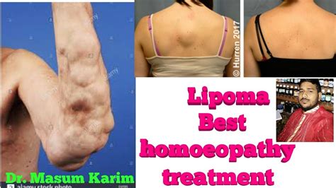 Lipoma Homeopathy Best Medicine How To Treatment Lipoma Without