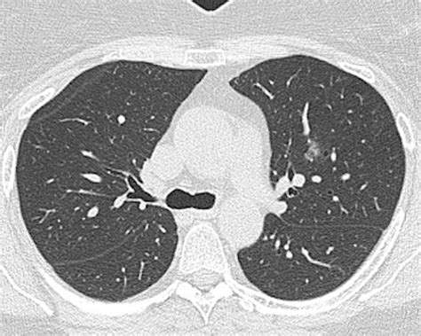 Incidental Findings On Cardiac Ct Scans Medical Forum