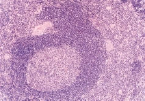 Mantle Cell Lymphoma Mantle Zone Pattern Hx And E X 100 Download