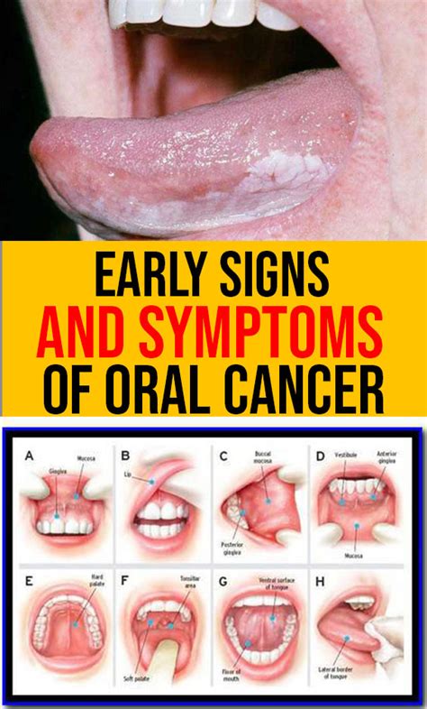 Early Signs And Symptoms Of Oral Cancer Women