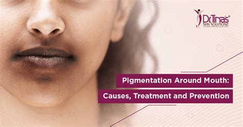 Pigmentation Around Mouth Causes Treatment And Prevention Skin