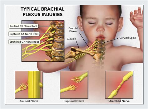 Types Of Birth Injuries Cerebral Palsy Erb S Palsy Brachial Plexus