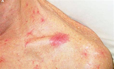 Spider Angioma Symptoms Causes Pictures Treatment