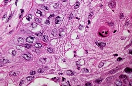 How to use carcinoma in a sentence. What is Squamous Cell Carcinoma? | SE Radiation Oncology Group
