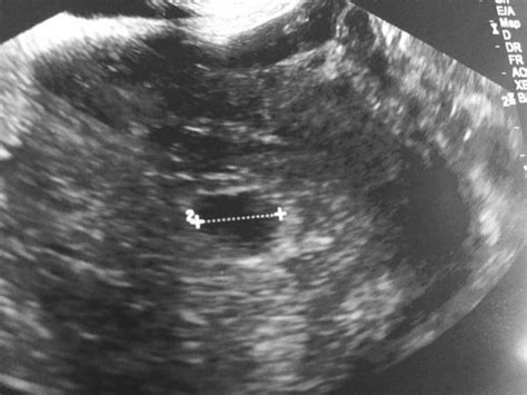 To ultrasound or not to ultrasound? (Cross posted) First ultrasound at 5-6 weeks ...