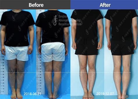 Increasing Height By Leg Lengthening Surgery How To Grow Taller Tone