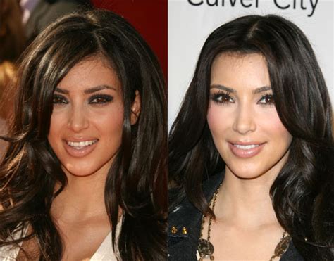 Kim Kardashian Plastic Surgery Before And After Plastic Celebrity Surgery