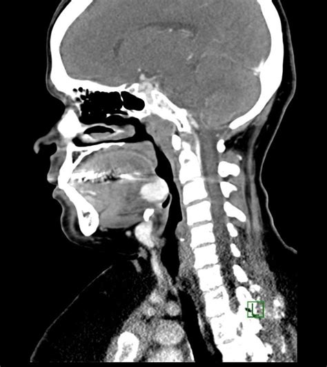 Ectopic Thyroid Pacs