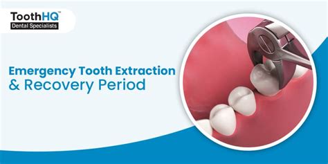Emergency Tooth Extraction And Recovery Period Toothhq Dental Specialist