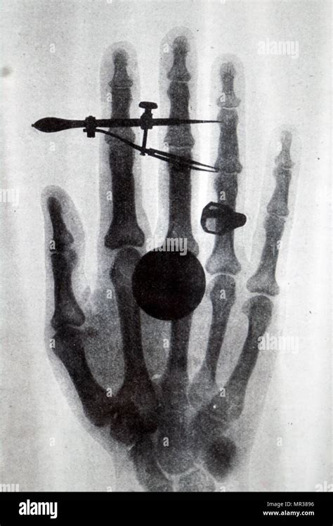 William Roentgen Invented X Rays