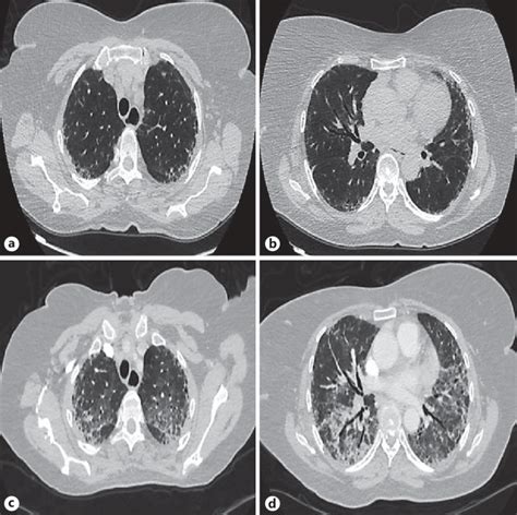 Hrct Images Of The Chest Revealing Subpleural Interstitial Thickening