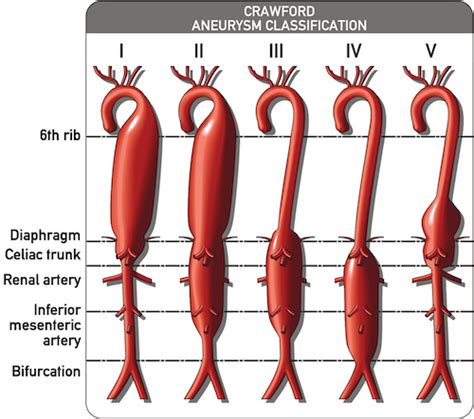 Thoracic Aortic Aneurysm The Operative Review Of Surgery