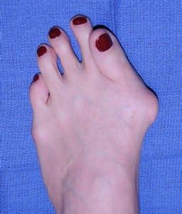 Severe Bunion Dr Moy S Painless Bunion Surgery