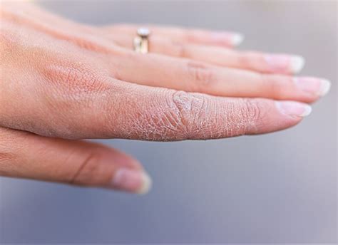Eczema Fingertips
