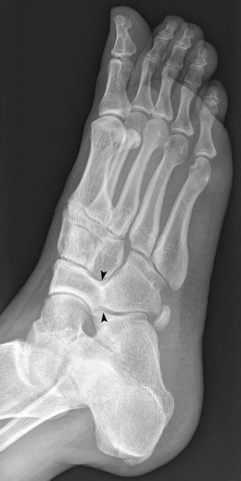 Frontal A And Oblique B X Ray Image Of The Right Foot Show An