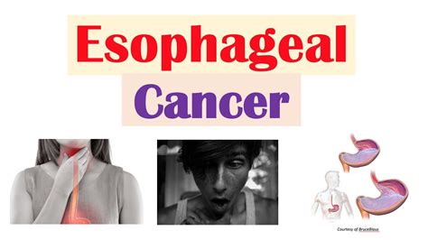 Esophageal Cancer Risk Factors Pathogenesis Signs And Symptoms