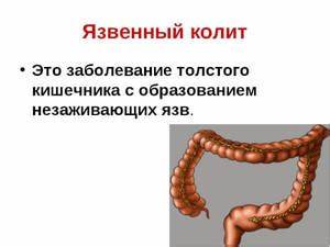 Язвенный колит диета рецепты Язвенный колит: последствия заболевания кишечника, правильное питание Язвенный колит: последствия заболевания кишечника, правильное питание Язвенный колит диета рецепты