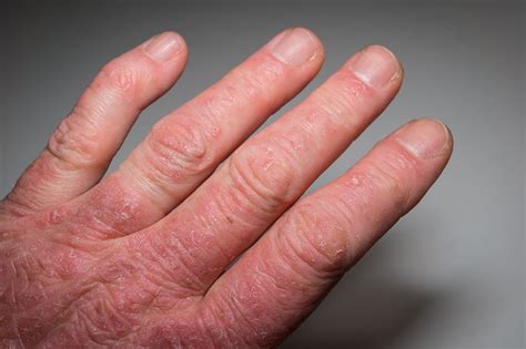Psoriatic Arthritis Symptoms Causes Diagnosis