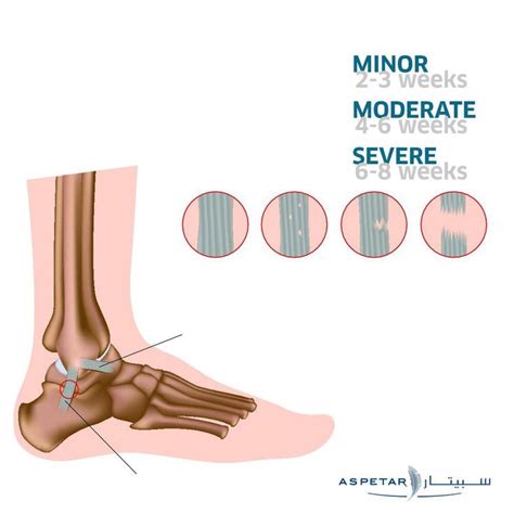 Severity Of Ankle Sprain Timeline Fracture Healing Healthcare